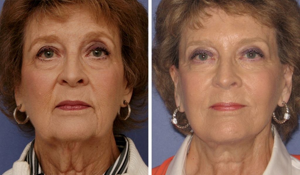before & after facelift female patient front view