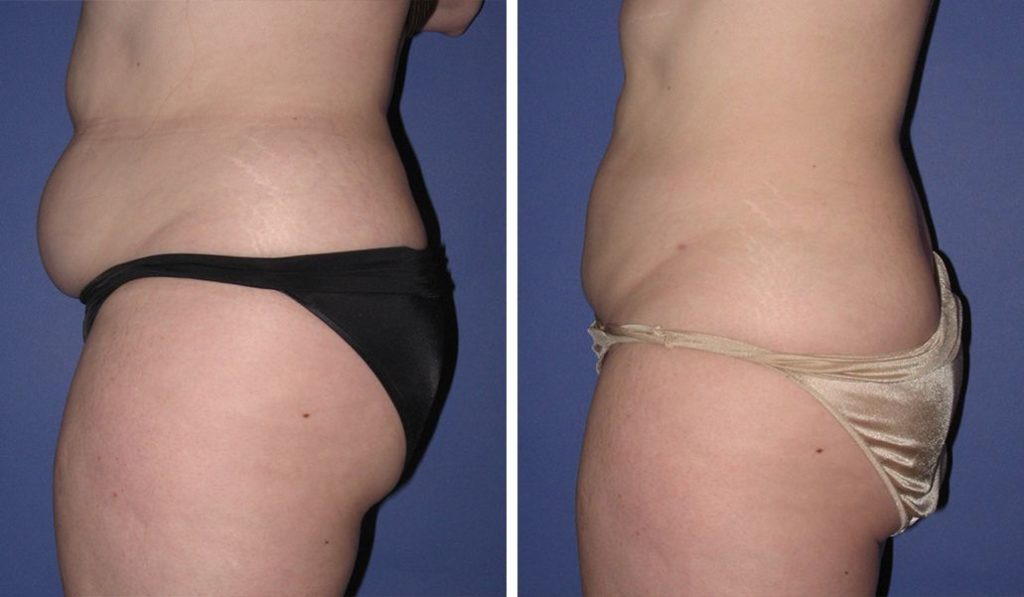 before & after liposuction female patient side profile