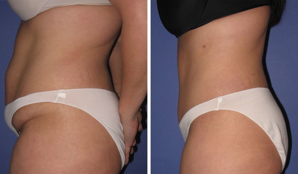 before & after liposuction female patient side profile