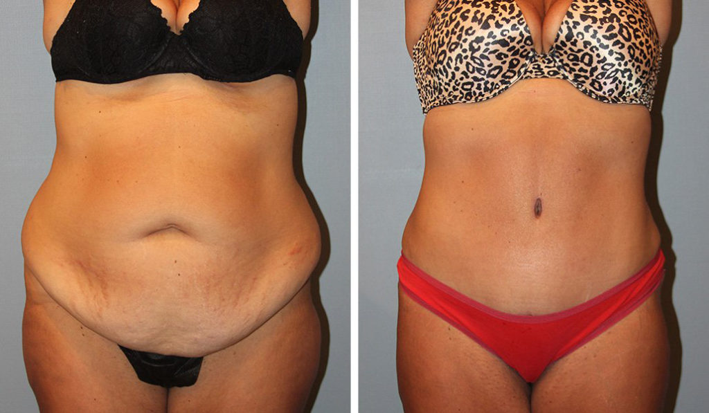 before & after tummy tuck female patient front view