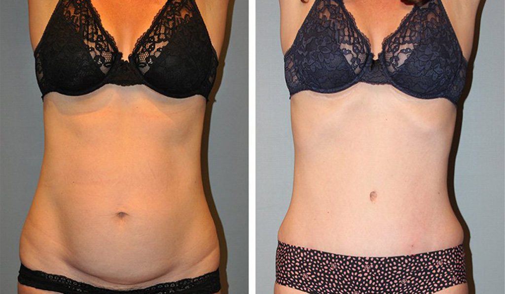 before & after tummy tuck female patient front view