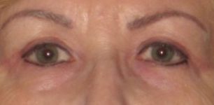 Patient Blepharoplasty | Eyelid Surgery Thumbnail After 0