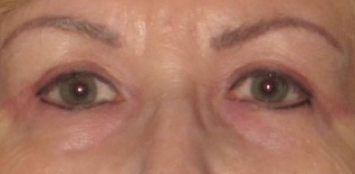 Patient Blepharoplasty | Eyelid Surgery Before 0