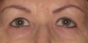 Patient Blepharoplasty | Eyelid Surgery Thumbnail Before 0