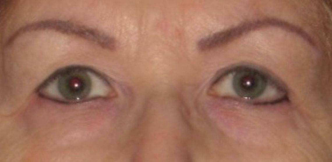 Patient Blepharoplasty | Eyelid Surgery Before 0