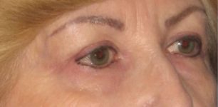 Patient Blepharoplasty | Eyelid Surgery Thumbnail After 1