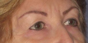 Patient Blepharoplasty | Eyelid Surgery Thumbnail Before 1