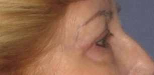 after Blepharoplasty / Eyelid Surgery zoomed side view Case 1630