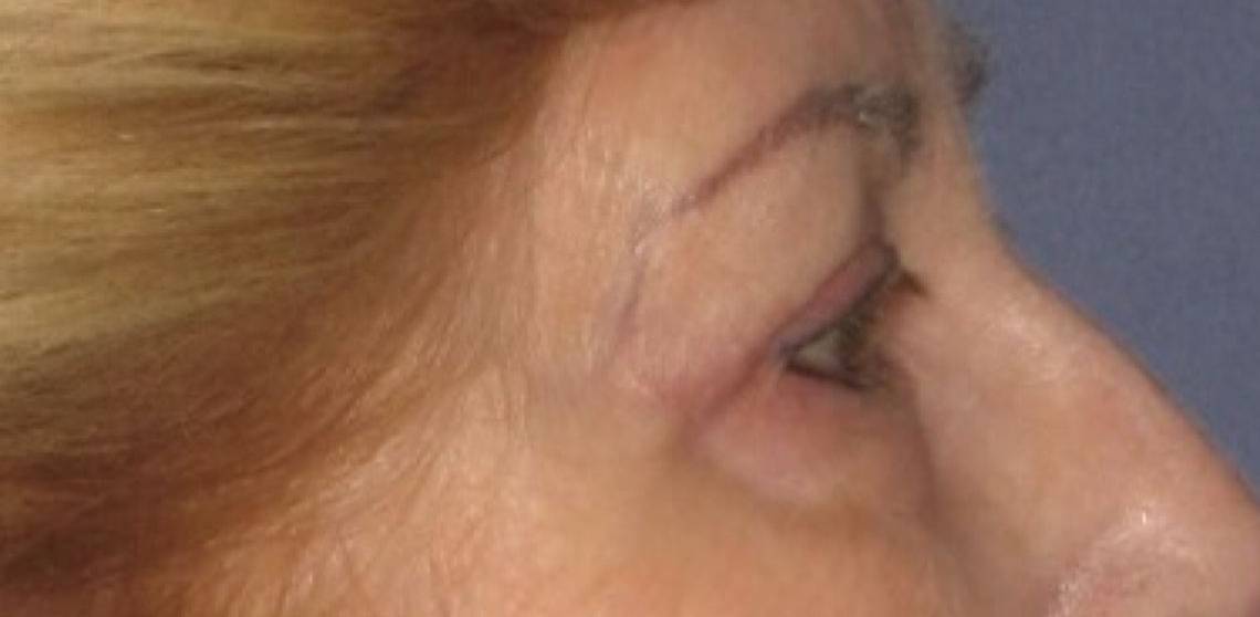 Patient Blepharoplasty | Eyelid Surgery Before 2