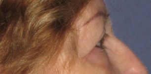 Patient Blepharoplasty | Eyelid Surgery Thumbnail Before 2