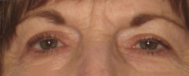 Patient Blepharoplasty | Eyelid Surgery Before 0