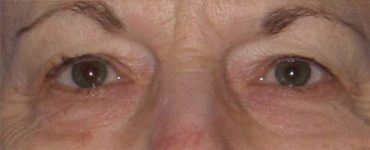 before Blepharoplasty / Eyelid Surgery zoomed front view Case 1637