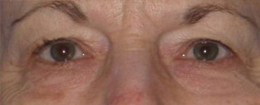 Patient Blepharoplasty | Eyelid Surgery Thumbnail Before 0