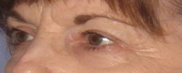 after Blepharoplasty / Eyelid Surgery zoomed diagonal view Case 1637