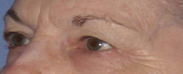 Patient Blepharoplasty | Eyelid Surgery Thumbnail Before 1