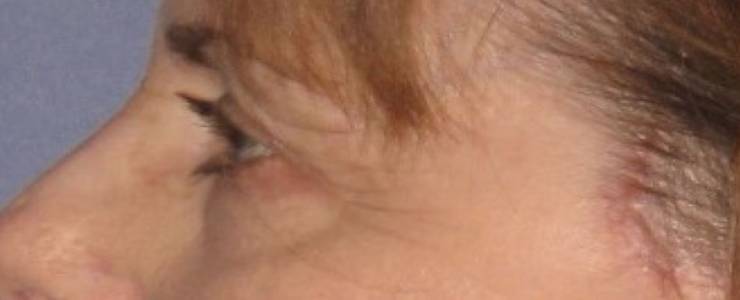 after Blepharoplasty / Eyelid Surgery zoomed side view Case 1637