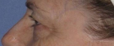 Patient Blepharoplasty | Eyelid Surgery Thumbnail Before 2