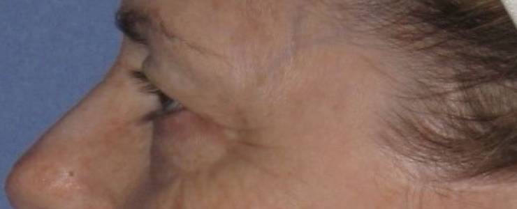 Patient Blepharoplasty | Eyelid Surgery Before 2