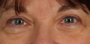 Patient Blepharoplasty | Eyelid Surgery Thumbnail After 0