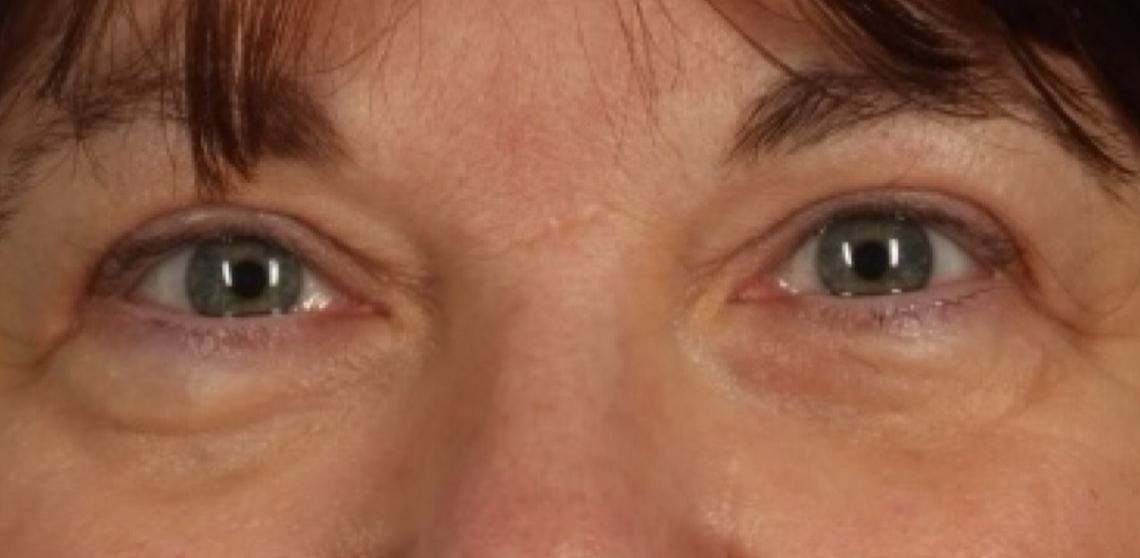 Patient Blepharoplasty | Eyelid Surgery Before 0