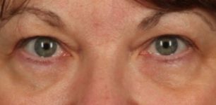 Patient Blepharoplasty | Eyelid Surgery Thumbnail Before 0