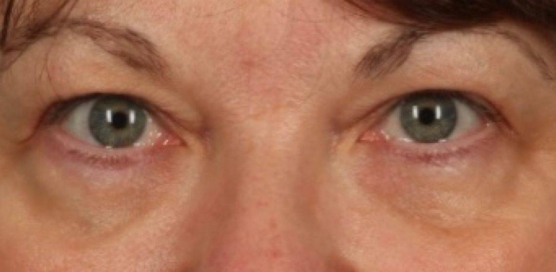 Patient Blepharoplasty | Eyelid Surgery Before 0