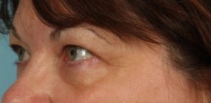 Patient Blepharoplasty | Eyelid Surgery Thumbnail Before 1