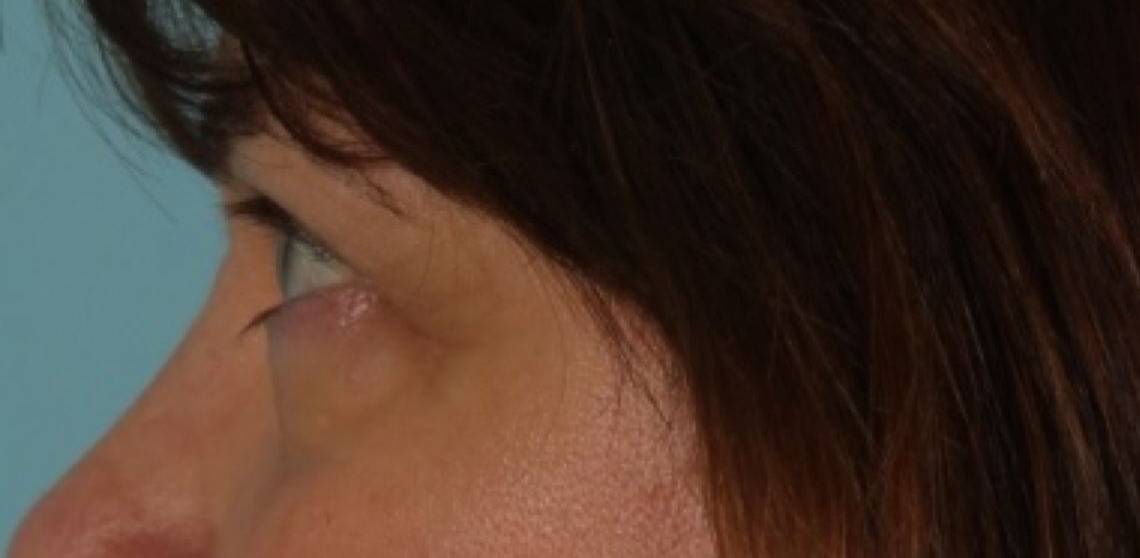 after Blepharoplasty / Eyelid Surgery zoomed side view Case 1644