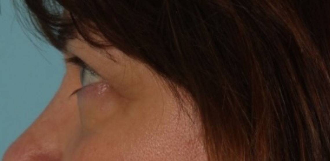 Patient Blepharoplasty | Eyelid Surgery Before 2