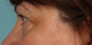 before Blepharoplasty / Eyelid Surgery zoomed side view Case 1644