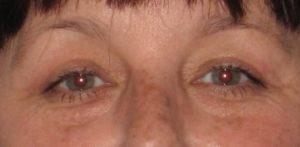 after Blepharoplasty / Eyelid Surgery zoomed front view Case 1651