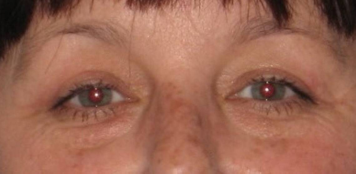 after Blepharoplasty / Eyelid Surgery zoomed front view Case 1651