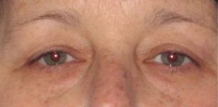 Patient Blepharoplasty | Eyelid Surgery Thumbnail Before 0