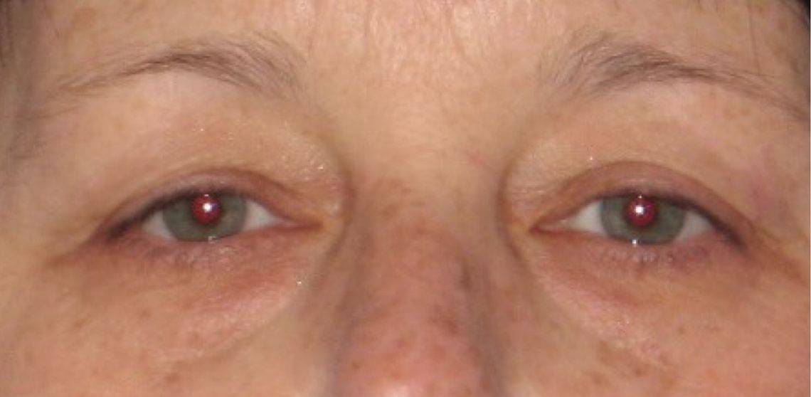 Patient Blepharoplasty | Eyelid Surgery Before 0