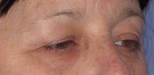 before Blepharoplasty / Eyelid Surgery zoomed diagonal view Case 1651