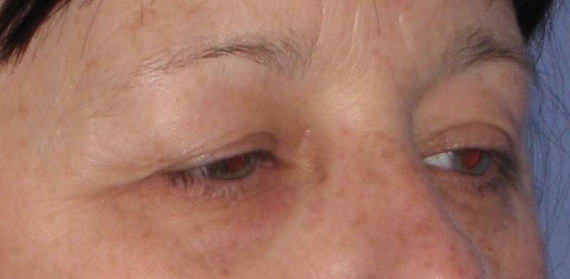 Patient Blepharoplasty | Eyelid Surgery Before 1