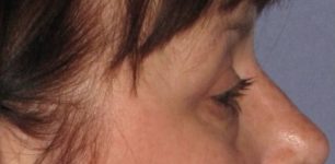 Patient Blepharoplasty | Eyelid Surgery Thumbnail After 2