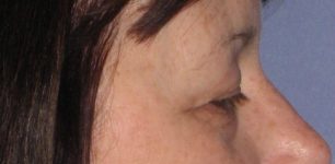 before Blepharoplasty / Eyelid Surgery zoomed side view Case 1651