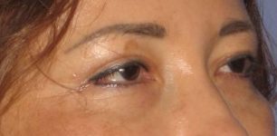 after Blepharoplasty / Eyelid Surgery zoomed diagonal view Case 1658