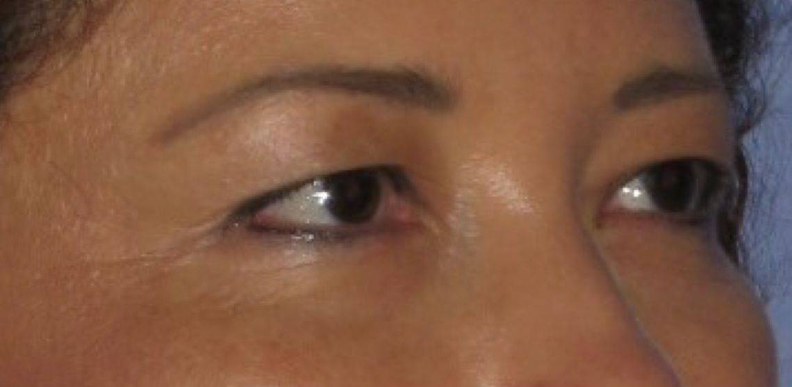 before Blepharoplasty / Eyelid Surgery zoomed diagonal view Case 1658