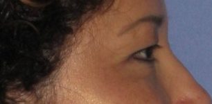 before Blepharoplasty / Eyelid Surgery zoomed side view Case 1658