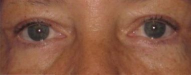 Patient Blepharoplasty | Eyelid Surgery Thumbnail After 0