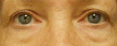 before Blepharoplasty / Eyelid Surgery zoomed front view Case 1666