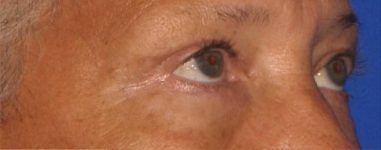 Patient Blepharoplasty | Eyelid Surgery Thumbnail After 1