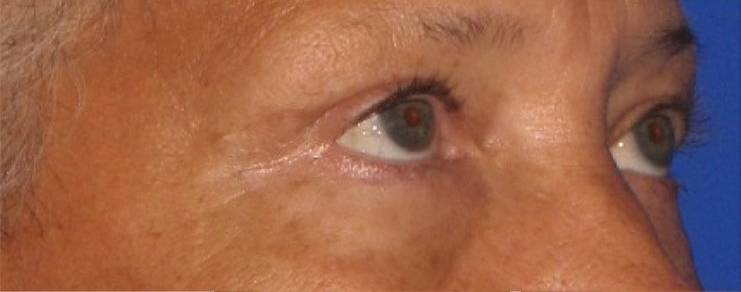 after Blepharoplasty / Eyelid Surgery zoomed diagonal view Case 1666