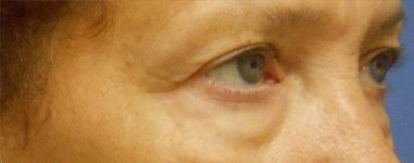 Patient Blepharoplasty | Eyelid Surgery Thumbnail Before 1