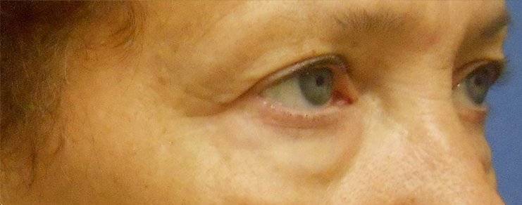 Patient Blepharoplasty | Eyelid Surgery Before 1