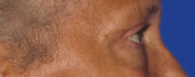 Patient Blepharoplasty | Eyelid Surgery Thumbnail After 2