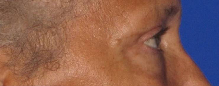 Patient Blepharoplasty | Eyelid Surgery Before 2