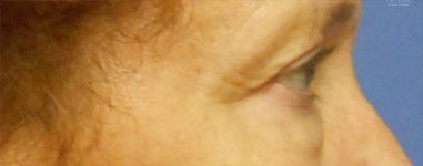 Patient Blepharoplasty | Eyelid Surgery Thumbnail Before 2